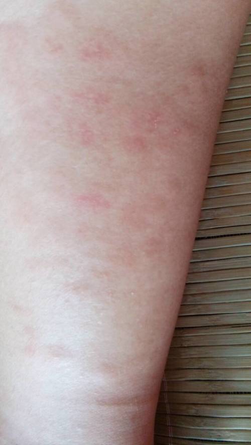 皮肤过敏起皮痒怎么办（过敏的皮肤起皮了怎么办）,皮肤过敏起皮痒怎么办（过敏的皮肤起皮了怎么办）,第2张