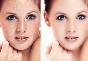 皮肤激光祛斑(皮肤激光祛斑后注意事项),第1张 皮肤激光祛斑(皮肤激光祛斑后注意事项),皮肤激光祛斑(皮肤激光祛斑后注意事项),第1张