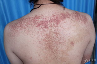 鱼鳞状皮肤病图片(鱼鳞皮肤病临床表现),第3张 鱼鳞状皮肤病图片(鱼鳞皮肤病临床表现),鱼鳞状皮肤病图片(鱼鳞皮肤病临床表现),第3张