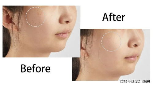 皮肤激光祛斑(皮肤激光祛斑后注意事项),第2张 皮肤激光祛斑(皮肤激光祛斑后注意事项),皮肤激光祛斑(皮肤激光祛斑后注意事项),第2张