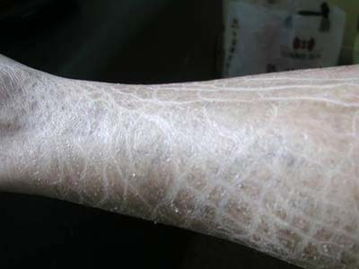 鱼鳞状皮肤病图片(鱼鳞皮肤病临床表现),第1张 鱼鳞状皮肤病图片(鱼鳞皮肤病临床表现),鱼鳞状皮肤病图片(鱼鳞皮肤病临床表现),第1张