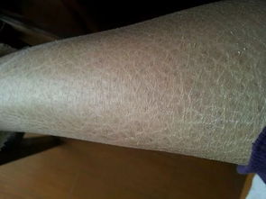 鱼鳞状皮肤病图片(鱼鳞皮肤病临床表现),第2张 鱼鳞状皮肤病图片(鱼鳞皮肤病临床表现),鱼鳞状皮肤病图片(鱼鳞皮肤病临床表现),第2张