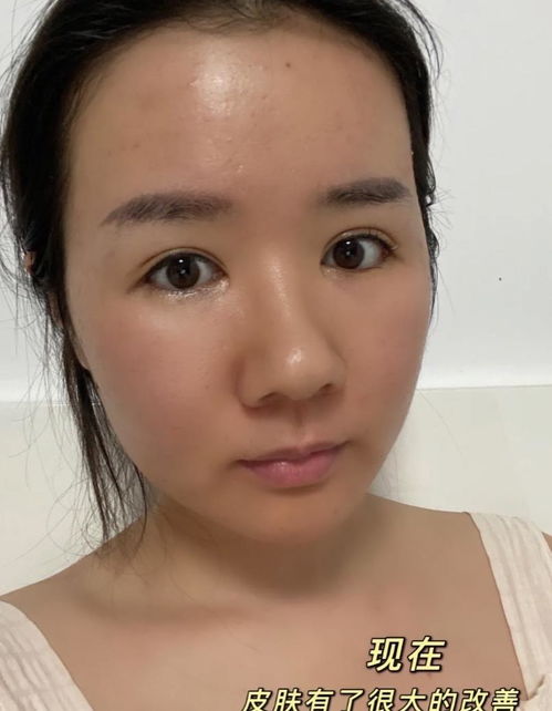 果酸换肤后皮肤会怎样(靠前次果酸换肤后皮肤没变化),第1张 果酸换肤后皮肤会怎样(靠前次果酸换肤后皮肤没变化),果酸换肤后皮肤会怎样(靠前次果酸换肤后皮肤没变化),第1张