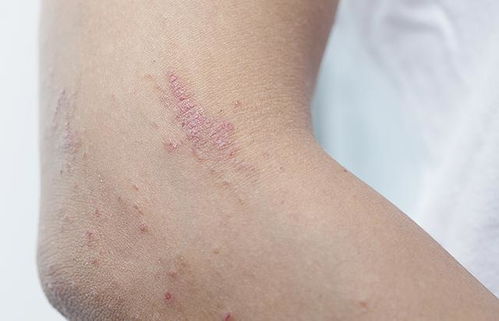 皮肤过敏起皮痒怎么办（过敏的皮肤起皮了怎么办）,皮肤过敏起皮痒怎么办（过敏的皮肤起皮了怎么办）,第3张