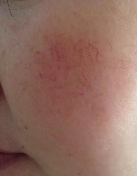 皮肤毛躁发红(皮肤发红毛糙),第3张 皮肤毛躁发红(皮肤发红毛糙),皮肤毛躁发红(皮肤发红毛糙),第3张