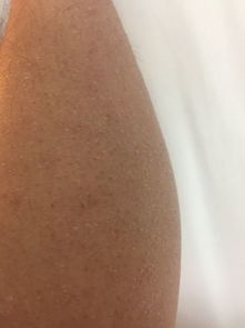 皮肤老是起皮怎么办啊(皮肤爱起皮是什么原因),第1张 皮肤老是起皮怎么办啊(皮肤爱起皮是什么原因),皮肤老是起皮怎么办啊(皮肤爱起皮是什么原因),第1张