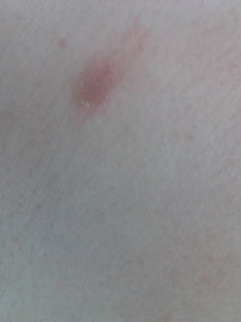 皮肤表面的日晒斑(皮肤表面有红血斑图片),第1张 皮肤表面的日晒斑(皮肤表面有红血斑图片),皮肤表面的日晒斑(皮肤表面有红血斑图片),第1张