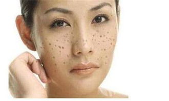 皮肤色素沉着怎么内调和治疗(皮肤色素沉着斑块怎么回事),第3张 皮肤色素沉着怎么内调和治疗(皮肤色素沉着斑块怎么回事),皮肤色素沉着怎么内调和治疗(皮肤色素沉着斑块怎么回事),第3张