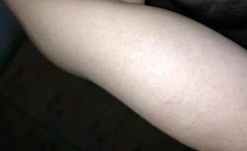 鸡皮肤会好嘛(鸡皮肤会好吗),第2张 鸡皮肤会好嘛(鸡皮肤会好吗),鸡皮肤会好嘛(鸡皮肤会好吗),第2张