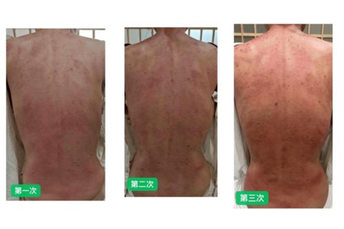 针炙能治皮肤病吗（针灸治皮肤病多长时间见效）,针炙能治皮肤病吗（针灸治皮肤病多长时间见效）,第2张