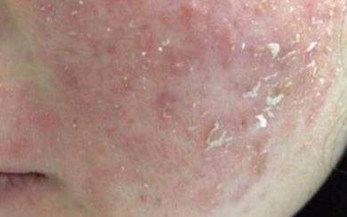 皮肤干红刺痛什么问题（皮肤干红肿刺痛怎么办）,皮肤干红刺痛什么问题（皮肤干红肿刺痛怎么办）,第3张