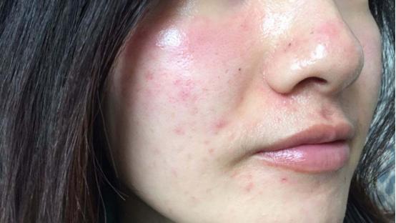 脸上皮肤过敏反复痒痒是什么原因（脸上皮肤过敏怎么快速修复）,脸上皮肤过敏反复痒痒是什么原因（脸上皮肤过敏怎么快速修复）,第2张