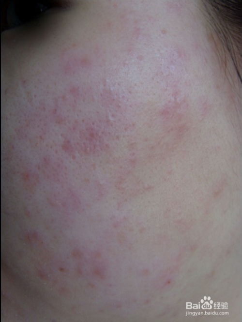 湿疹用什么药（湿疹用什么药治疗最好）,湿疹用什么药（湿疹用什么药治疗最好）,第1张