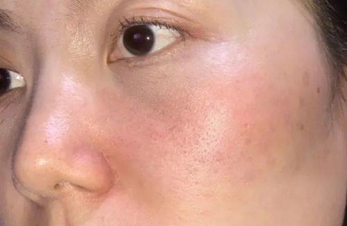 皮肤干红刺痛什么问题（皮肤干红肿刺痛怎么办）,皮肤干红刺痛什么问题（皮肤干红肿刺痛怎么办）,第1张