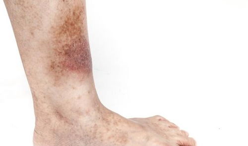 小腿皮肤鱼鳞偏方(糖尿病小腿皮肤像鱼鳞),第3张 小腿皮肤鱼鳞偏方(糖尿病小腿皮肤像鱼鳞),小腿皮肤鱼鳞偏方(糖尿病小腿皮肤像鱼鳞),第3张