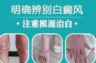 皮肤薄怎么治(皮肤薄怎么治疗最有效),第2张 皮肤薄怎么治(皮肤薄怎么治疗最有效),皮肤薄怎么治(皮肤薄怎么治疗最有效),第2张