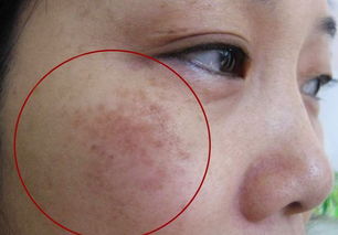 改善脸皮肤男(让脸脱皮能不能改善皮肤),第2张 改善脸皮肤男(让脸脱皮能不能改善皮肤),改善脸皮肤男(让脸脱皮能不能改善皮肤),第2张