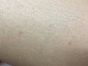 皮肤起了包痒有干皮(皮肤痒还有包),第2张 皮肤起了包痒有干皮(皮肤痒还有包),皮肤起了包痒有干皮(皮肤痒还有包),第2张