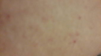 产后的皮肤(产后皮肤痒抓就起疙瘩),第1张 产后的皮肤(产后皮肤痒抓就起疙瘩),产后的皮肤(产后皮肤痒抓就起疙瘩),第1张