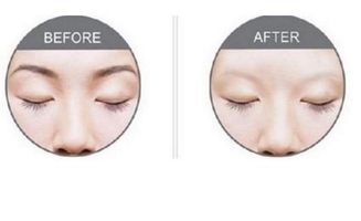 激光洗眉皮肤会烂吗(激光洗眉皮肤有破损正常吗),第3张 激光洗眉皮肤会烂吗(激光洗眉皮肤有破损正常吗),激光洗眉皮肤会烂吗(激光洗眉皮肤有破损正常吗),第3张