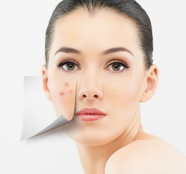 山东皮肤科祛痘(山东皮肤科祛痘专家),第2张 山东皮肤科祛痘(山东皮肤科祛痘专家),山东皮肤科祛痘(山东皮肤科祛痘专家),第2张