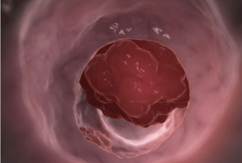 肠癌拉出来大便的图片(肠癌拉出来大便的图片早期症状),第3张 肠癌拉出来大便的图片(肠癌拉出来大便的图片早期症状),肠癌拉出来大便的图片(肠癌拉出来大便的图片早期症状),第3张