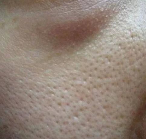 皮肤比较粗糙怎么办（皮肤粗糙怎么办能变细腻）,皮肤比较粗糙怎么办（皮肤粗糙怎么办能变细腻）,第3张