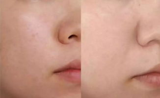 皮肤比较粗糙怎么办（皮肤粗糙怎么办能变细腻）,皮肤比较粗糙怎么办（皮肤粗糙怎么办能变细腻）,第2张