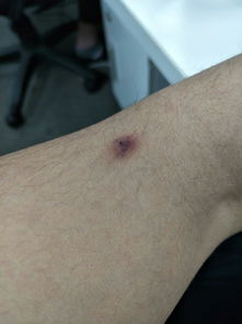 皮肤疙瘩怎么去除(皮肤疙瘩大全),第3张 皮肤疙瘩怎么去除(皮肤疙瘩大全),皮肤疙瘩怎么去除(皮肤疙瘩大全),第3张