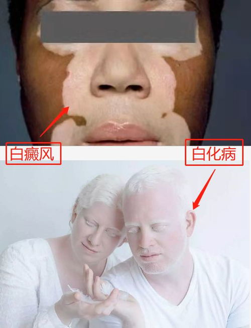 先天皮肤黑能变白吗(先天皮肤黑能变白吗图片),第3张 先天皮肤黑能变白吗(先天皮肤黑能变白吗图片),先天皮肤黑能变白吗(先天皮肤黑能变白吗图片),第3张