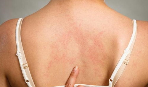 冬天皮肤痒怎么办(冬天皮肤痒怎么办有什么方法止痒),第1张 冬天皮肤痒怎么办(冬天皮肤痒怎么办有什么方法止痒),冬天皮肤痒怎么办(冬天皮肤痒怎么办有什么方法止痒),第1张