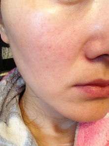 脸上皮肤反复瘙痒怎么办(脸上皮肤一直痒怎么办),第2张 脸上皮肤反复瘙痒怎么办(脸上皮肤一直痒怎么办),脸上皮肤反复瘙痒怎么办(脸上皮肤一直痒怎么办),第2张