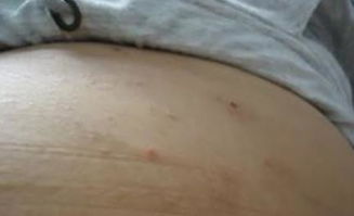 皮肤着凉发痒看中医好还是西医好(皮肤着凉发痒是什么原因呢),第1张 皮肤着凉发痒看中医好还是西医好(皮肤着凉发痒是什么原因呢),皮肤着凉发痒看中医好还是西医好(皮肤着凉发痒是什么原因呢),第1张