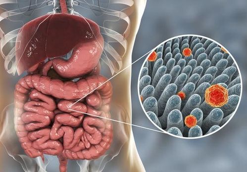 肠癌拉出来大便的图片(肠癌拉出来大便的图片早期症状),第1张 肠癌拉出来大便的图片(肠癌拉出来大便的图片早期症状),肠癌拉出来大便的图片(肠癌拉出来大便的图片早期症状),第1张
