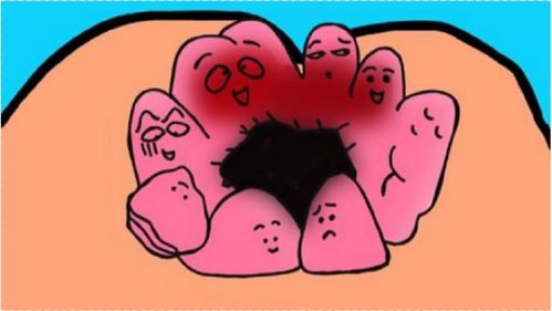 吃什么可以治痔疮(痔疮外痔肉球怎么消除),第1张 吃什么可以治痔疮(痔疮外痔肉球怎么消除),吃什么可以治痔疮(痔疮外痔肉球怎么消除),第1张