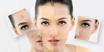 敏感皮肤如何去痘印（如何加快皮肤代谢去痘印）,敏感皮肤如何去痘印（如何加快皮肤代谢去痘印）,第3张