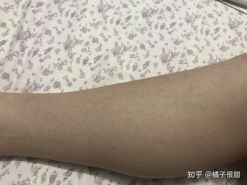 鸡皮肤会好嘛(鸡皮肤会好吗),第1张 鸡皮肤会好嘛(鸡皮肤会好吗),鸡皮肤会好嘛(鸡皮肤会好吗),第1张