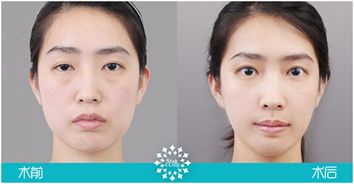 瘦脸针皮肤松弛（瘦脸针后皮肤松弛）,瘦脸针皮肤松弛（瘦脸针后皮肤松弛）,第1张