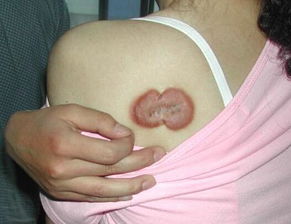 皮肤有结节是怎么回事(皮肤有结节是什么原因),第2张 皮肤有结节是怎么回事(皮肤有结节是什么原因),皮肤有结节是怎么回事(皮肤有结节是什么原因),第2张