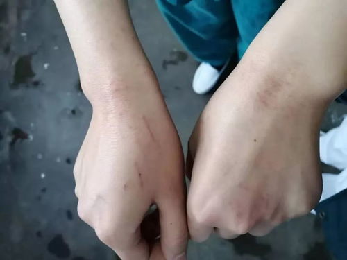 皮肤一压印(皮肤一压就有印痕),第2张 皮肤一压印(皮肤一压就有印痕),皮肤一压印(皮肤一压就有印痕),第2张