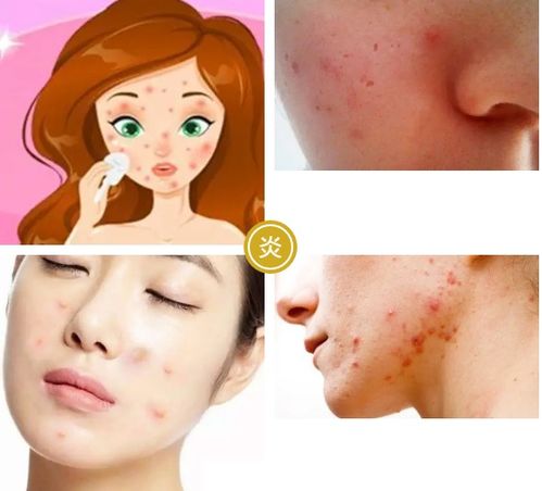 皮肤局部泛红（皮肤局部泛红是怎么回事）,皮肤局部泛红（皮肤局部泛红是怎么回事）,第1张