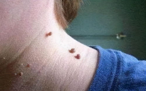 皮肤上有肿块的原因(皮肤上有肿块图片大全),第2张 皮肤上有肿块的原因(皮肤上有肿块图片大全),皮肤上有肿块的原因(皮肤上有肿块图片大全),第2张