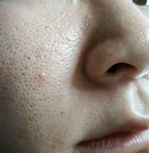 男士脸部皮肤毛孔堵塞(男士脸上毛孔粗大怎么办坑坑洼洼),第3张 男士脸部皮肤毛孔堵塞(男士脸上毛孔粗大怎么办坑坑洼洼),男士脸部皮肤毛孔堵塞(男士脸上毛孔粗大怎么办坑坑洼洼),第3张