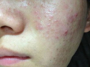 面部皮肤硬化（面部皮肤硬化增厚痒是什么病）,面部皮肤硬化（面部皮肤硬化增厚痒是什么病）,第1张