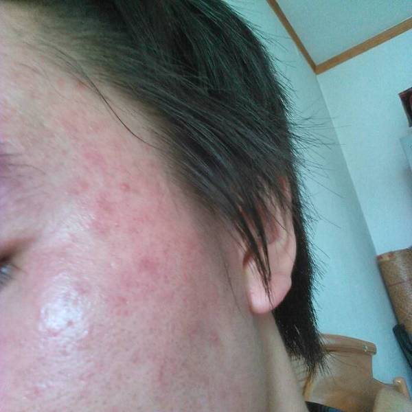 痘痘周边的皮肤腐烂(痘痘周围起皮是要好了吗),第3张 痘痘周边的皮肤腐烂(痘痘周围起皮是要好了吗),痘痘周边的皮肤腐烂(痘痘周围起皮是要好了吗),第3张