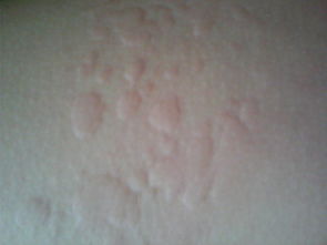 皮肤起了包痒有干皮(皮肤痒还有包),第1张 皮肤起了包痒有干皮(皮肤痒还有包),皮肤起了包痒有干皮(皮肤痒还有包),第1张