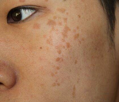 皮肤过敏后留下黑色素(皮肤过敏留下黑色素沉淀),第3张 皮肤过敏后留下黑色素(皮肤过敏留下黑色素沉淀),皮肤过敏后留下黑色素(皮肤过敏留下黑色素沉淀),第3张