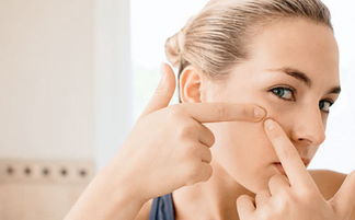 怎样治疗皮肤青春痘(怎样治疗青春痘最有效),第1张 怎样治疗皮肤青春痘(怎样治疗青春痘最有效),怎样治疗皮肤青春痘(怎样治疗青春痘最有效),第1张