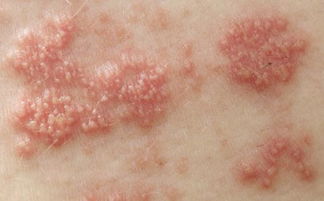 夏天皮肤过敏瘙痒怎么办(夏天皮肤过敏瘙痒怎么办呢),第3张 夏天皮肤过敏瘙痒怎么办(夏天皮肤过敏瘙痒怎么办呢),夏天皮肤过敏瘙痒怎么办(夏天皮肤过敏瘙痒怎么办呢),第3张