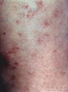 皮肤病图片对照大全查看图片（皮肤病图片对照大全查看图片皮炎）,皮肤病图片对照大全查看图片（皮肤病图片对照大全查看图片皮炎）,第2张